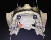 Dr Steve Bernier/Spécialiste/Implants dentaires